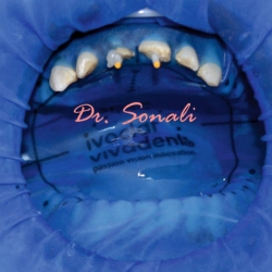 Root Canal Access Opening in Ravet & Moshi – Skilled Care